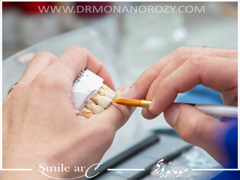 فرایند نصب لمینت دندان
