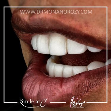 ترمیم دندان‌های آسیب‌دیده و اصلاح طرح لبخند